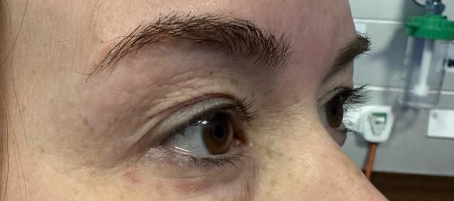 Upper eyelid surgery, patient 1 — Before