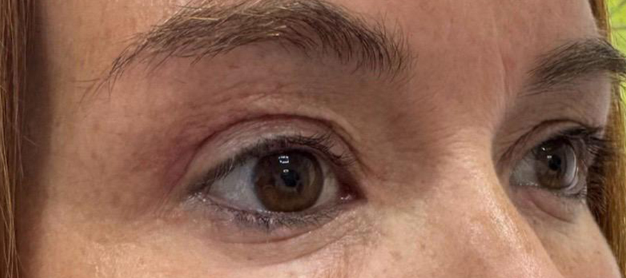Upper eyelid surgery, patient 1 — After