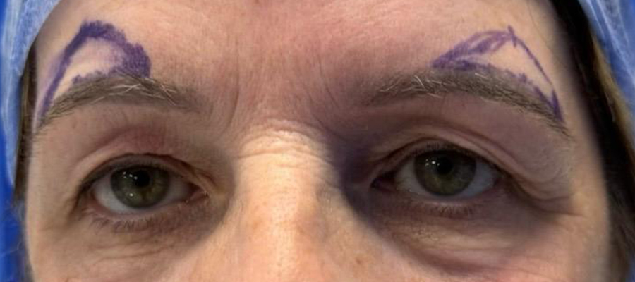 Upper eyelid surgery, patient 2 — Before