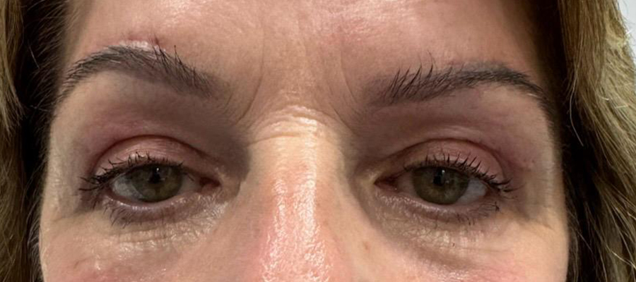 Upper eyelid surgery, patient 2 — After