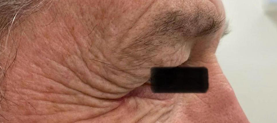 Upper eyelid surgery, patient 3 — Before
