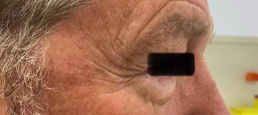 Upper eyelid surgery, patient 3 — After
