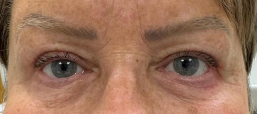 Upper eyelid surgery, patient 4 — Before