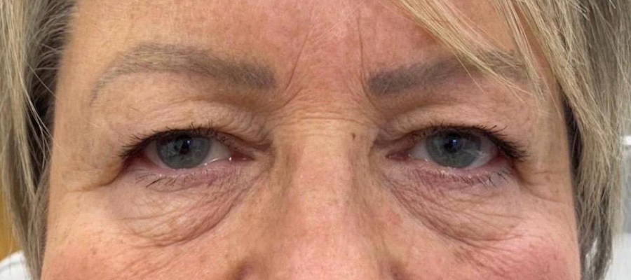 Upper eyelid surgery, patient 4 — After